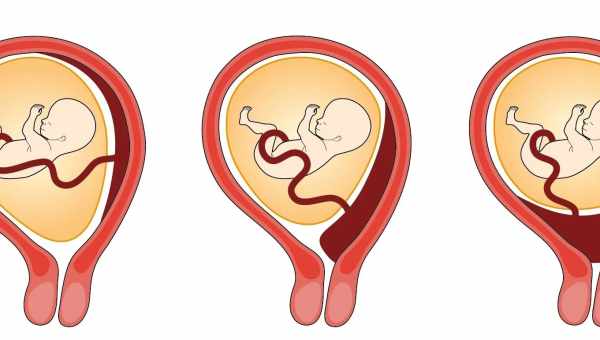 Виды расположения плаценты: по передней, задней и боковой стенке матки, опасность низкой плацентации