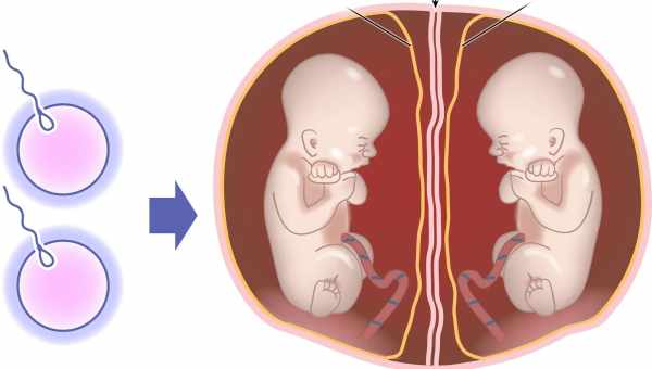 Виды и особенности многоплодной беременности, причины возникновения, роды при многоплодии
