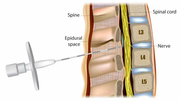 В чем разница между эпидуральной и спинальной анестезией, какая безопаснее и что лучше выбрать?
