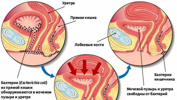 Почему во время менструации или перед ней болит влагалище, как избавиться от боли при месячных?