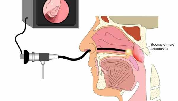Аденоиды у детей 1, 2 и 3 степени – лечение без операции или удаление?