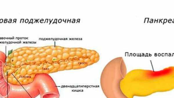 Воспаление поджелудочной железы — причины, симптомы и лечение. Воспаление поджелудочной железы — профилактика осложнений