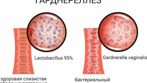 Гарднерелла у мужчин: причины, симптомы. Методы лечения гарднереллы у мужчин, профилактика заражения