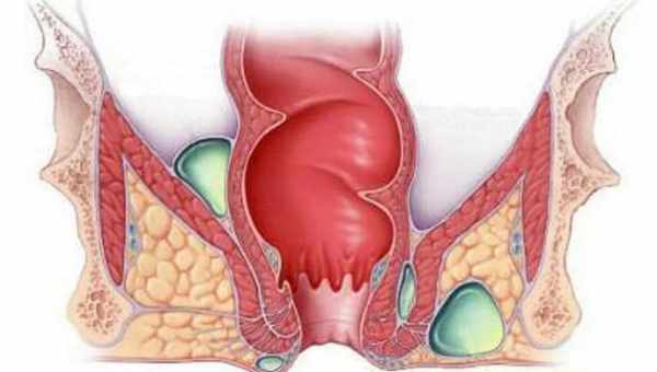 Выпадение прямой кишки: лечить в домашних условиях или срочно к врачу? Каким может быть лечение выпадения прямой кишки