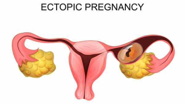 Всё о внематочной беременности — признаки, причины, лечение