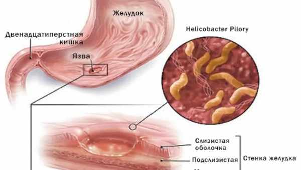 Гастрит — причины, симптомы, диагностика, лечение