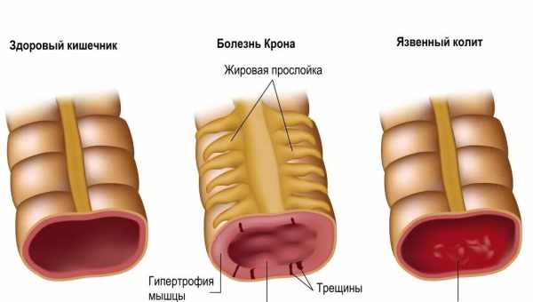 Что представляет собой колит кишечника, чем опасен? Симптомы колита кишечника, как его распознать и чем лечить: советы врача