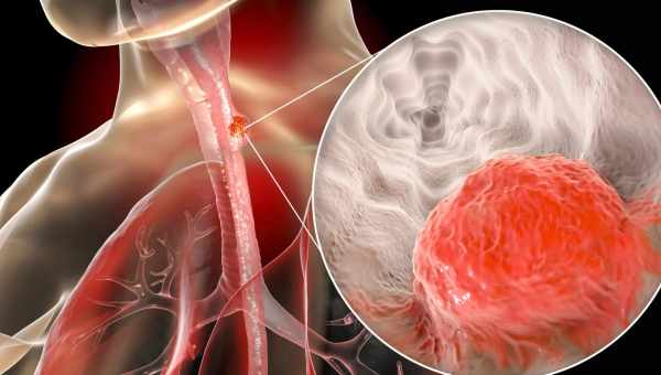 Полип пищевода – причины и первые симптомы, чем грозит такой диагноз. Лечение: виды операций, профилактика полипов пищевода