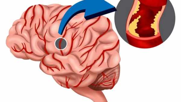 Атеросклероз сосудов головного мозга: симптомы и лечение. Что такое атеросклероз сосудов головного мозга, как он проявляется и чем опасен