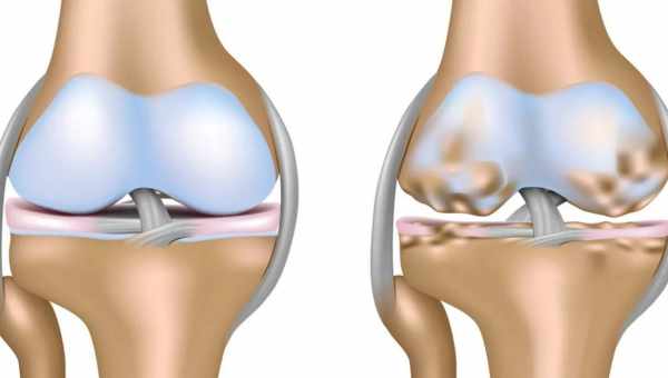 Антидепрессант остановил разрушение хрящей при остеоартрите