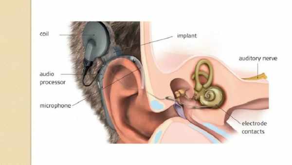 Создан универсальный имплант барабанной перепонки, полностью восстанавливающий слух