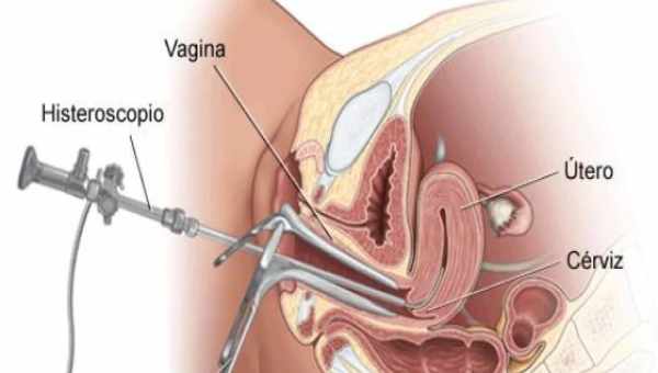 Гистероскопия матки – что это такое?