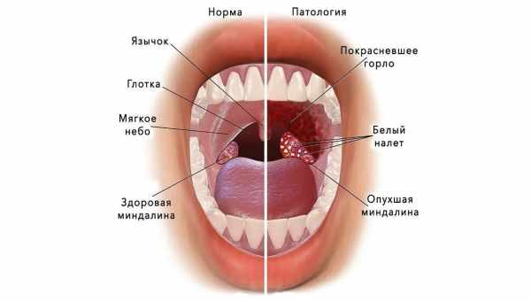 Абсцесс гланд