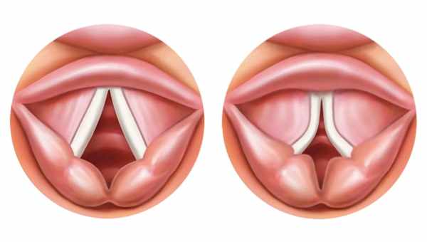 Гранулема голосовых связок