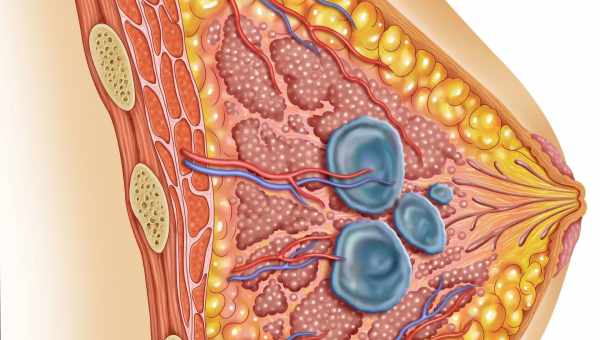 Киста молочной железы – заболевание маммологии