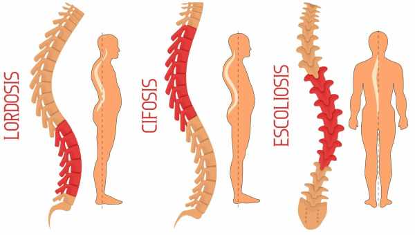 Искривления позвоночника: сколиоз, лордоз, кифоз