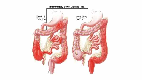 Кал с кровью – один из признаков язвенного колита