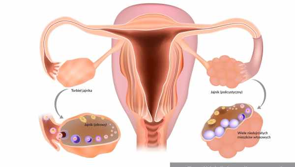 Синдром поликистозных яичников как причина бесплодия