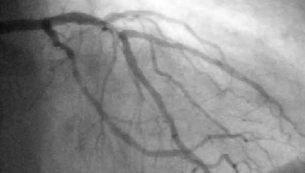 Коронарография (коронарная ангиография) - виды, показания и противопоказания, подготовка и проведение, возможные осложнения, отзывы и цена процедуры
