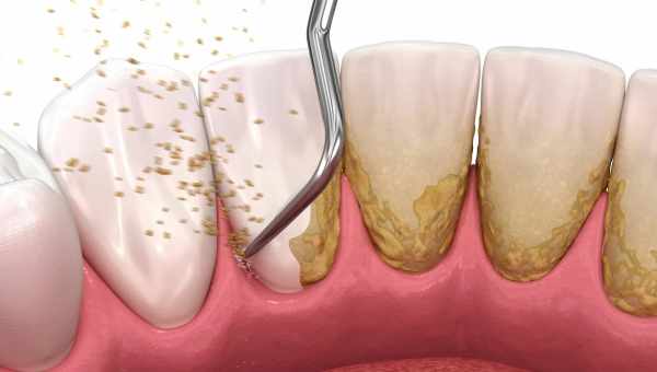 Зубной камень – причина развития пародонтита