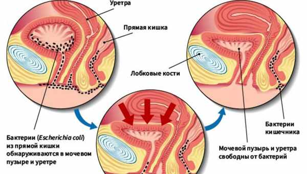 Боль в мочевом пузыре - характер, причины, лечение