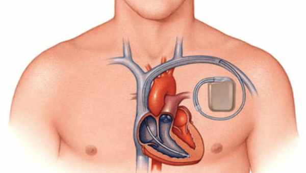 Кардиостимулятор зарядили при помощи ультразвука. Как работает эта чудо-технология?