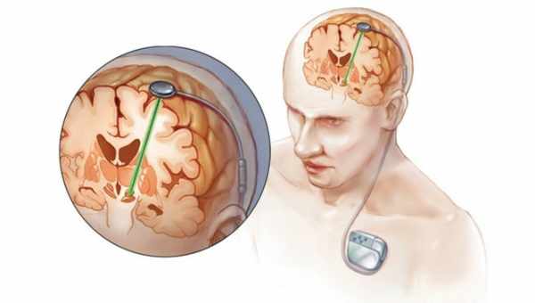 Глубокая стимуляция мозга: кто и зачем вживляет чипы в мозг человека
