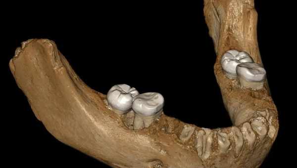 На челюсти человека-предшественника нашли неверно расположенный зуб мудрости